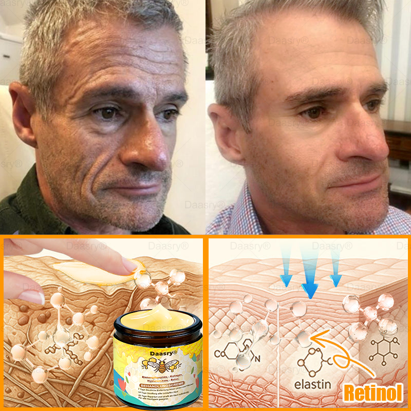 🔥 🇩🇪Made & Shipped from Germany | Clinically Inspired: Daasry® Bee Venom Treatment Cream with bee venom peptides, hyaluronic acid, collagen, and triple peptides💧. Targets wrinkles, sagging, stretch marks, age spots—firms, lifts, and rejuvenates.