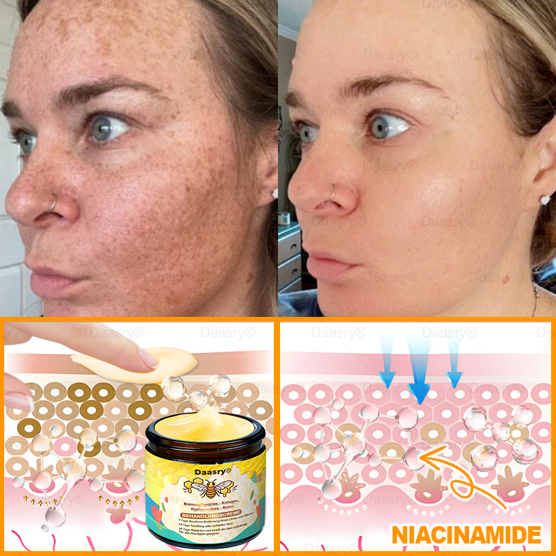 🔥 🇩🇪Made & Shipped from Germany | Clinically Inspired: Daasry® Bee Venom Treatment Cream with bee venom peptides, hyaluronic acid, collagen, and triple peptides💧. Targets wrinkles, sagging, stretch marks, age spots—firms, lifts, and rejuvenates.